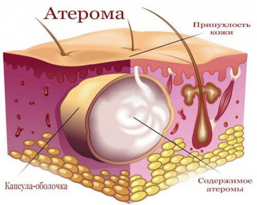 ateroma-stroenie